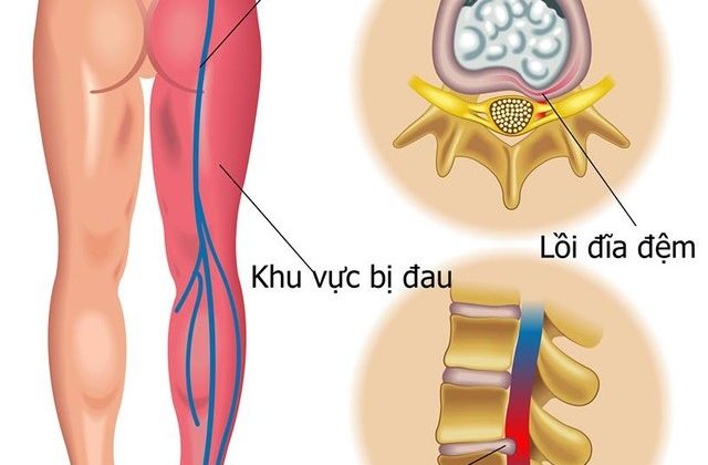 Thoát vị đĩa đệm vùng thắt lưng là nguyên nhân phổ biến nhất.