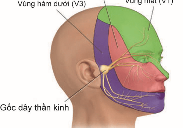 Đau dây thần kinh số 5 là sự tổn thương từ một trong ba nhánh hoặc cả ba nhánh.