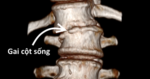 Cách trị gai cột sống tại nhà đơn giản, hiệu quả nhất