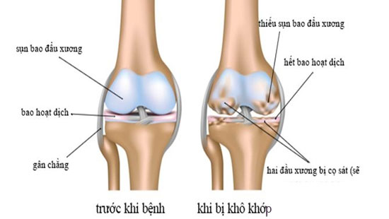 Hình ảnh khô khớp