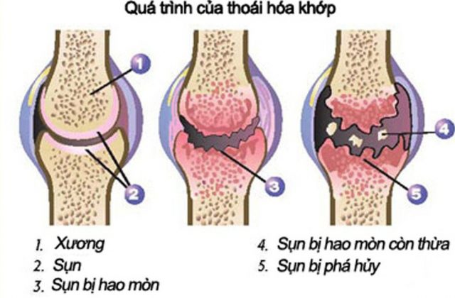 Bệnh thoái hóa khớp gối