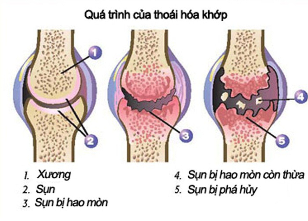 Bệnh thoái hóa khớp gối và nguy cơ tàn phế