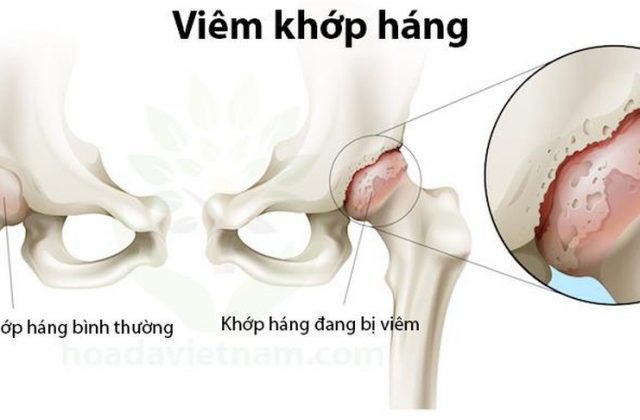 Bệnh viêm khớp háng xuất hiện những cơn đau nhức kéo dài ở vùng háng