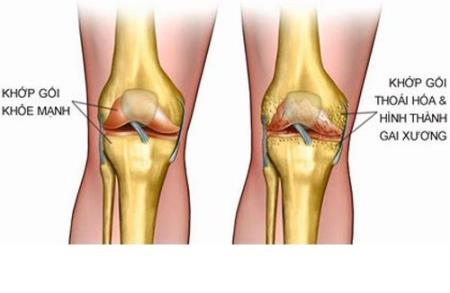 Hình ảnh thoái hóa khớp gối