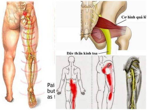 Đau nhức từ mông lan xuống bắp chân do đau thần kinh tọa