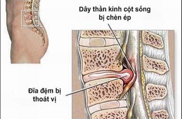 Hình ảnh thoát vị đĩa đệm