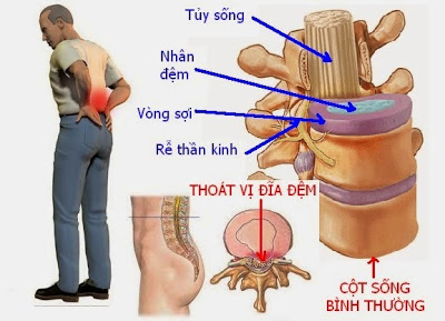 Thoát vị đĩa đệm làm đau nhức từ mông xuống bắp chân