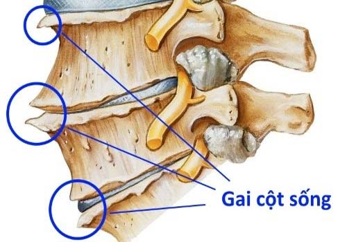 Gai đôi cột sống L5 | NỖI LO của nhiều bệnh nhân xương khớp