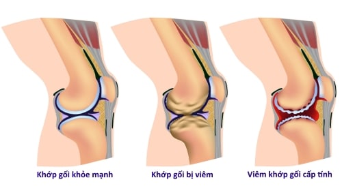 Tiếng kêu khi di chuyển ở gối là dấu hiệu báo trước bệnh viêm xương khớp