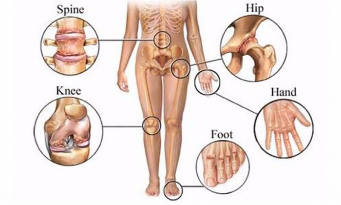 Thoái hóa đa khớp | Dấu hiệu đau từ 5 khớp trở lên