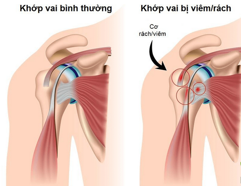 Hình ảnh bệnh viêm khớp vai