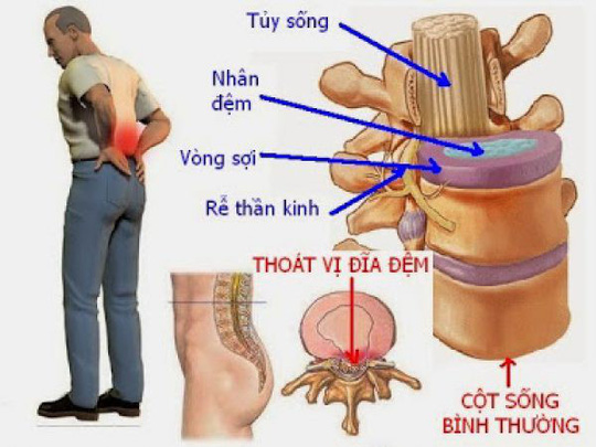 Mô tả về chứng bệnh thoát vị đĩa đệm