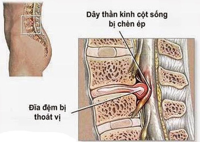 Bệnh thoát vị đĩa đệm là gì? Có nguy hiểm không?