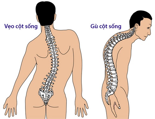 Cột sống bị biến dạng do thoái hóa (Ảnh minh họa)