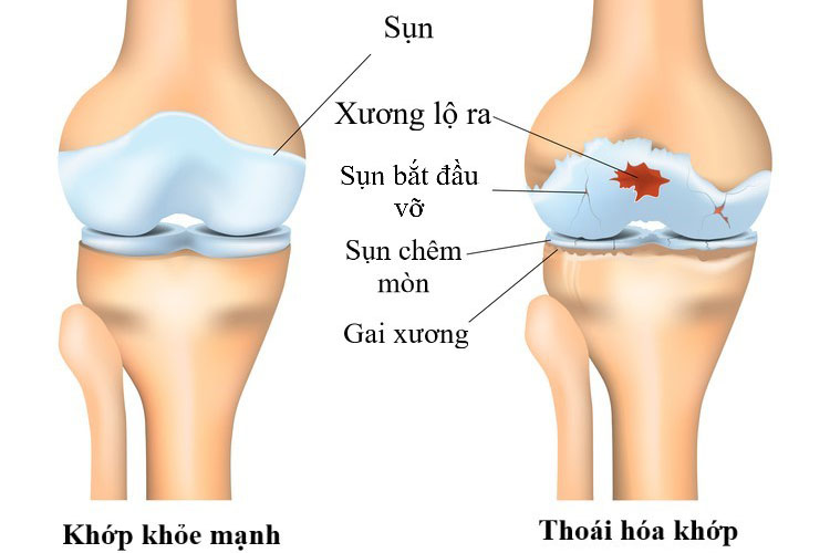 Thoái hóa khớp khiến người bệnh thường xuyên đau nhức, đi lại khó khăn