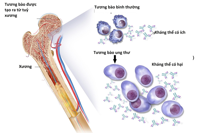 Bệnh nhân bị đa u tủy xương có triệu chứng mệt mỏi, suy nhược cơ thể, ăn uống kém, đau xương sườn, xương cột sống, đau khớp, đau đầu (Ảnh minh họa)