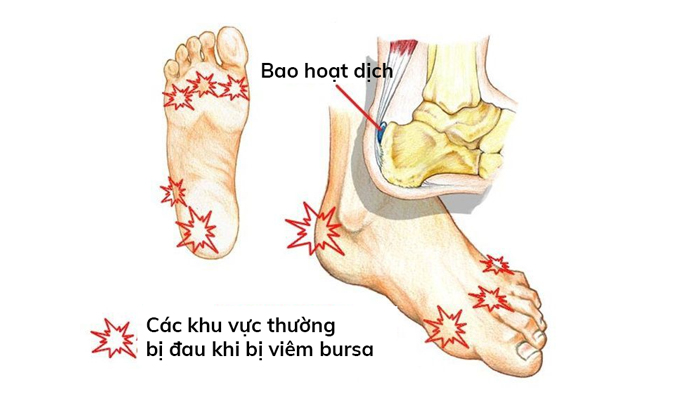 Các khu vực thường bị đau khi viêm bursa