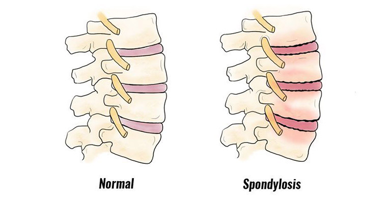 Cột sống khi bị thoái hóa (Ảnh minh họa)