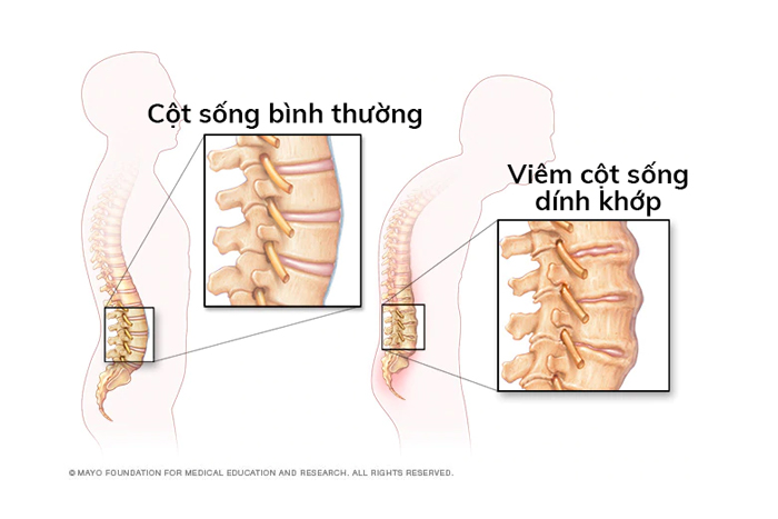 Viêm cột sống dính khớp có thể ảnh hưởng tới cả khu vực phía sau hoặc bên dưới gót chân (gân Achilles) (Ảnh minh họa)