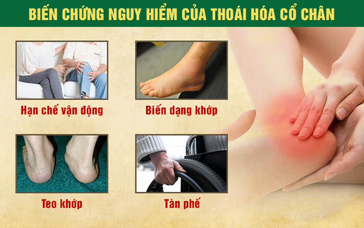 Biến chứng nguy hiểm của thoái hoá cổ chân