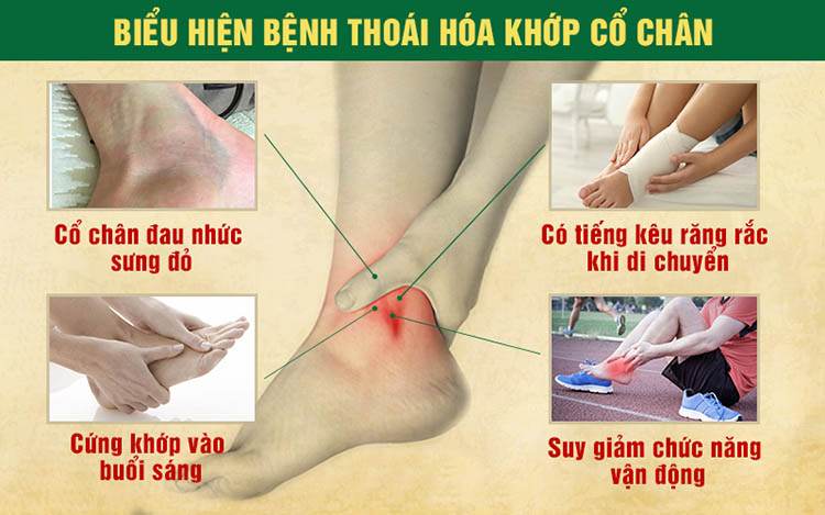 Biểu hiện bệnh thoái hoá khớp cổ chân