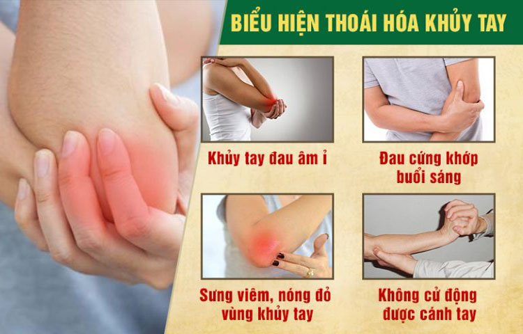 Triệu chứng của thoái hóa khớp khuỷu tay