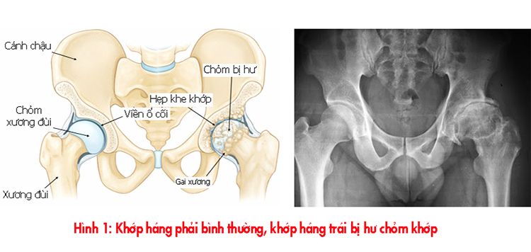 Thoái hóa khớp háng gây đau như thế nào?