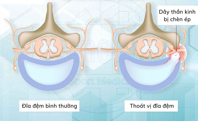 Thoát vị đĩa đệm ở cổ (Ảnh minh hoạ)