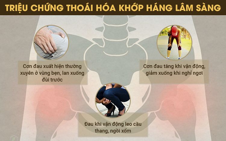 Triệu chứng thoái hóa khớp háng lâm sàng