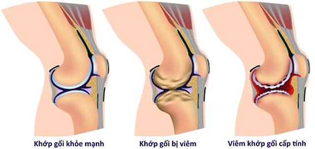 Bệnh viêm khớp gối có thể đau ở một hoặc cả hai bên gối