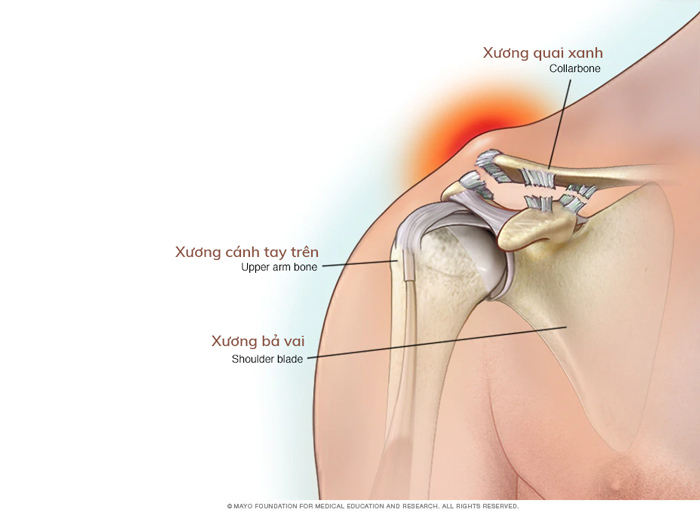 Chấn thương tách vai