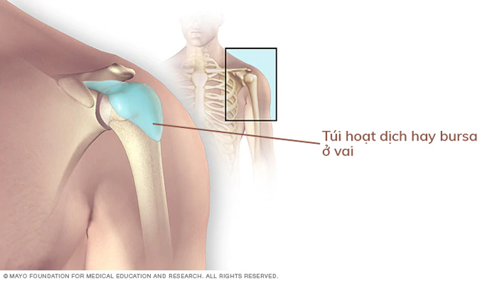 Viêm bursa hay bao hoạt dịch là những túi nhỏ chứa đầy chất lỏng