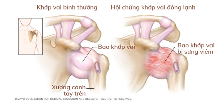 Hội chứng khớp vai đông lạnh