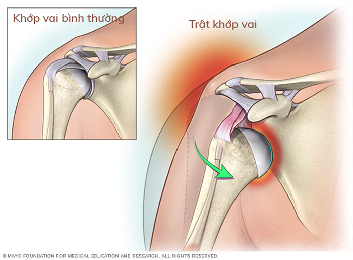 Trật khớp vai Là một chất thương, trong đó xương cánh tay trên của bạn bị trượt ra khỏi vị trí ổ cốc