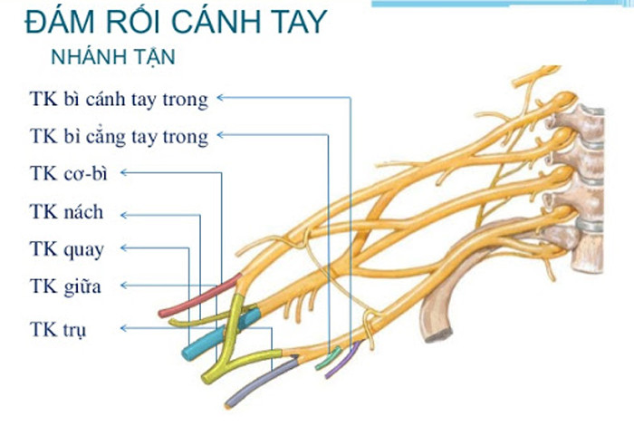 Chấn thương đám rối cánh tay