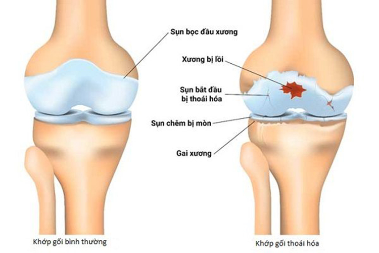 Hình ảnh minh họa thoái hóa khớp gối