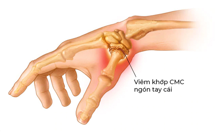 Viêm khớp thoái hóa ngón tay cái