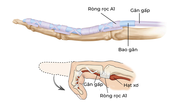 Ngón tay cò súng