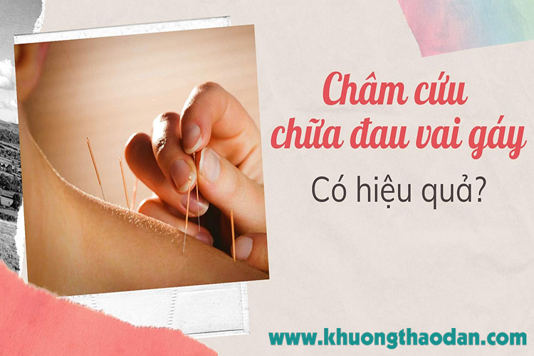 [GIẢI ĐÁP] Châm cứu đau vai gáy có thực sự hiệu quả?