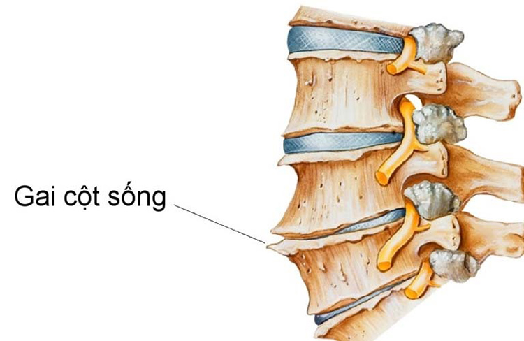 Gai cột sống chèn ép dây thần kinh gây đau nhức xương khớp tê bì chân tay