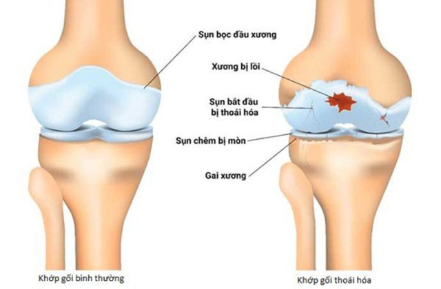 Hình ảnh mình họa cho bệnh lý thoái hóa khớp gối