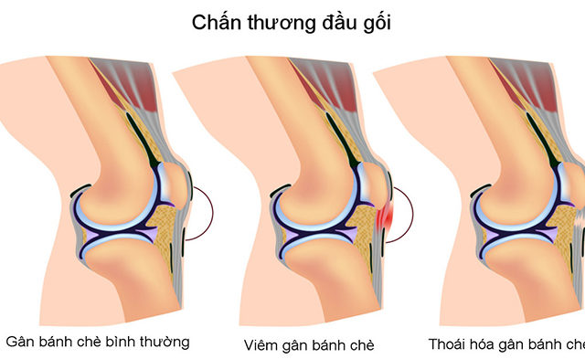 Gân bánh chè là phần nối giữa xương bánh chè và xương chày