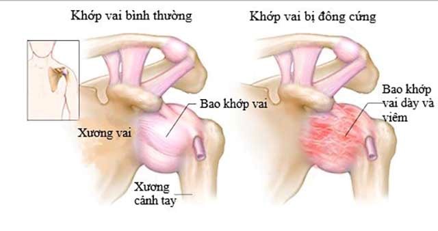 Đau khớp vai gây khó chịu cho người bệnh