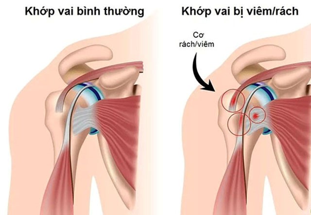 Viêm quanh khớp vai gây đau nhức, khó chịu